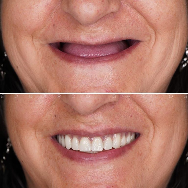 caso prótesis total