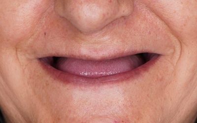 caso-protesis-total_1