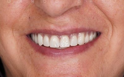 caso-protesis-total_3